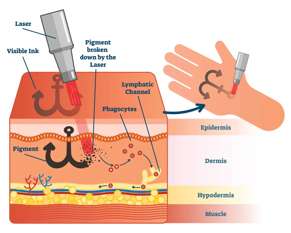 Detailed breakdown of the laser tattoo removal process, highlighting how laser technology targets and fragments tattoo pigments for natural elimination by the body.