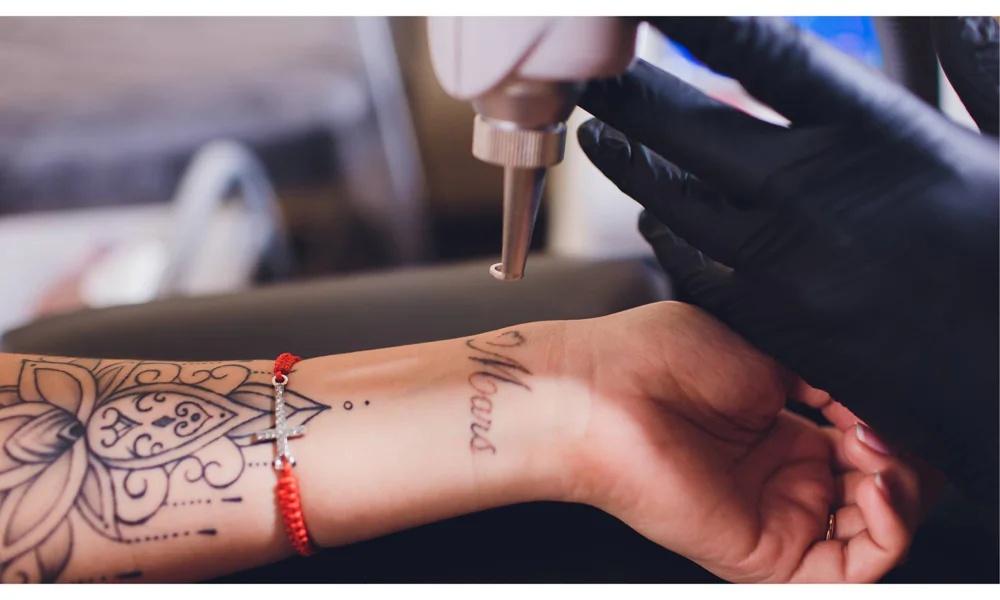 A professional removing a tattoo using a laser device, demonstrating the high-tech method of laser tattoo removal.