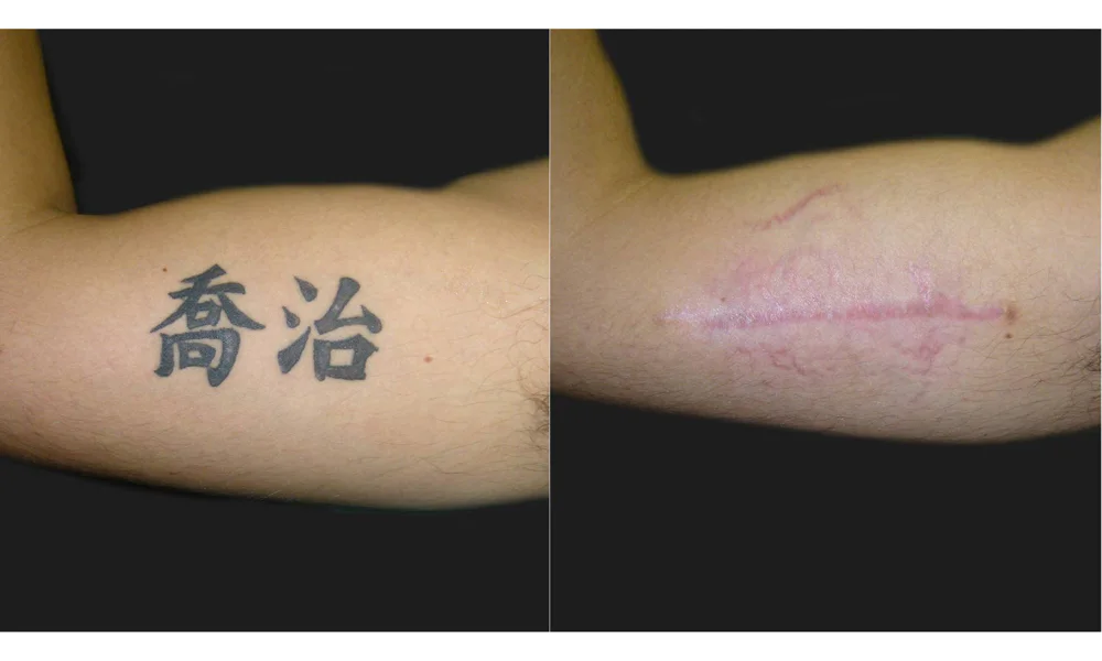A surgeon excising a tattoo, showcasing the surgical method of removing tattooed skin.