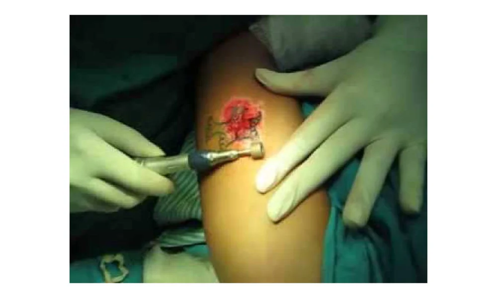 A high-speed rotary device performing dermabrasion on a tattoo, illustrating the abrasive skin removal process.
