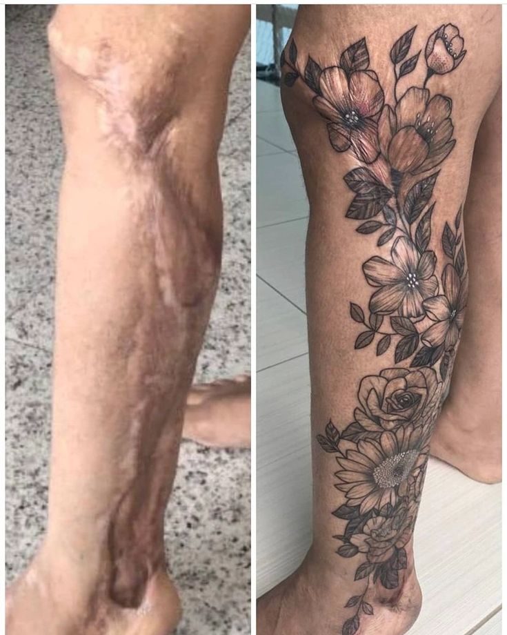 50 Times People Asked To Cover Up Their Scars, And This Tattoo Artist  Nailed It (New Pics)